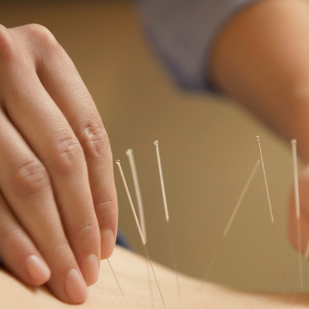 Acupuncture needles placed along the back