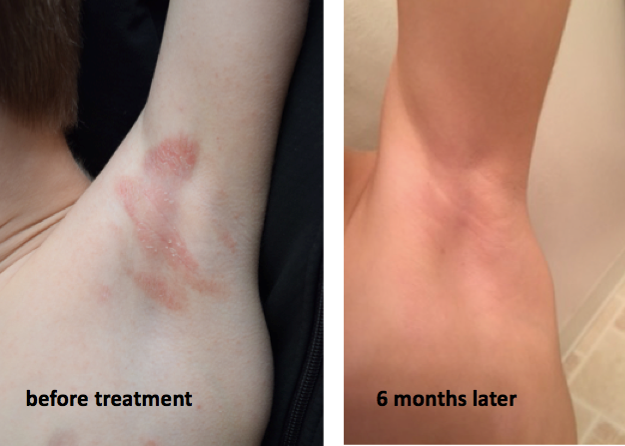Before and after photographs of a 5-year-old patient with eczema, taken at initial presentation and after six months of naturopathic treatment with Dr. Coleen Murphy