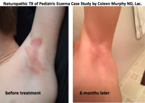 Eczema-Case-Study-before-after-300x213